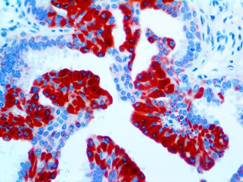 IHC of TAG-72 on an FFPE Breast Carcinoma Tissue